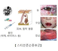 모든약으로 걸릴수있는 스티븐존슨 증후군 (난감) | 인스티즈