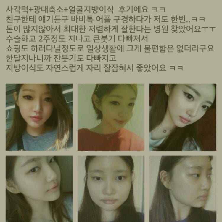 여자들 성형수술 후기.jpg | 인스티즈