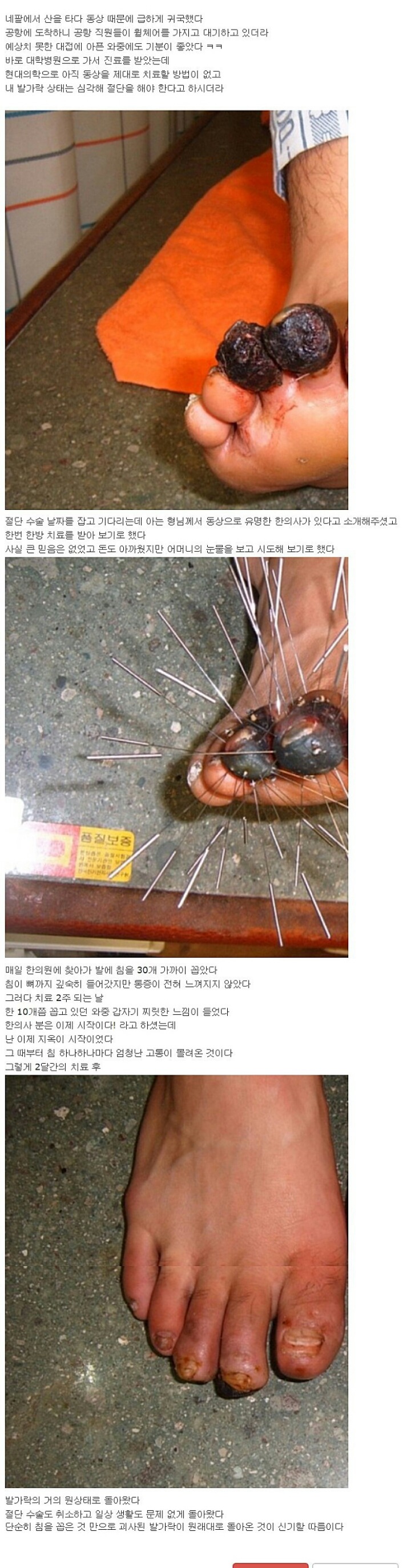 혐)주작 말 나오던 동상환자 침 치료 후기..jpg | 인스티즈